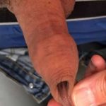 Foreskin Restoration